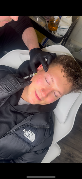 skin booster on males face