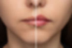 Lip Filler Enhancement