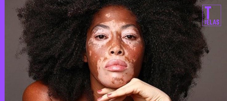 Vitiligo Pride 6 Mulheres Brasileiras Com Vitiligo Para Conhecer Vitiligo Pride 6 Mulheres Brasileiras Com Vitiligo Para Conhecer