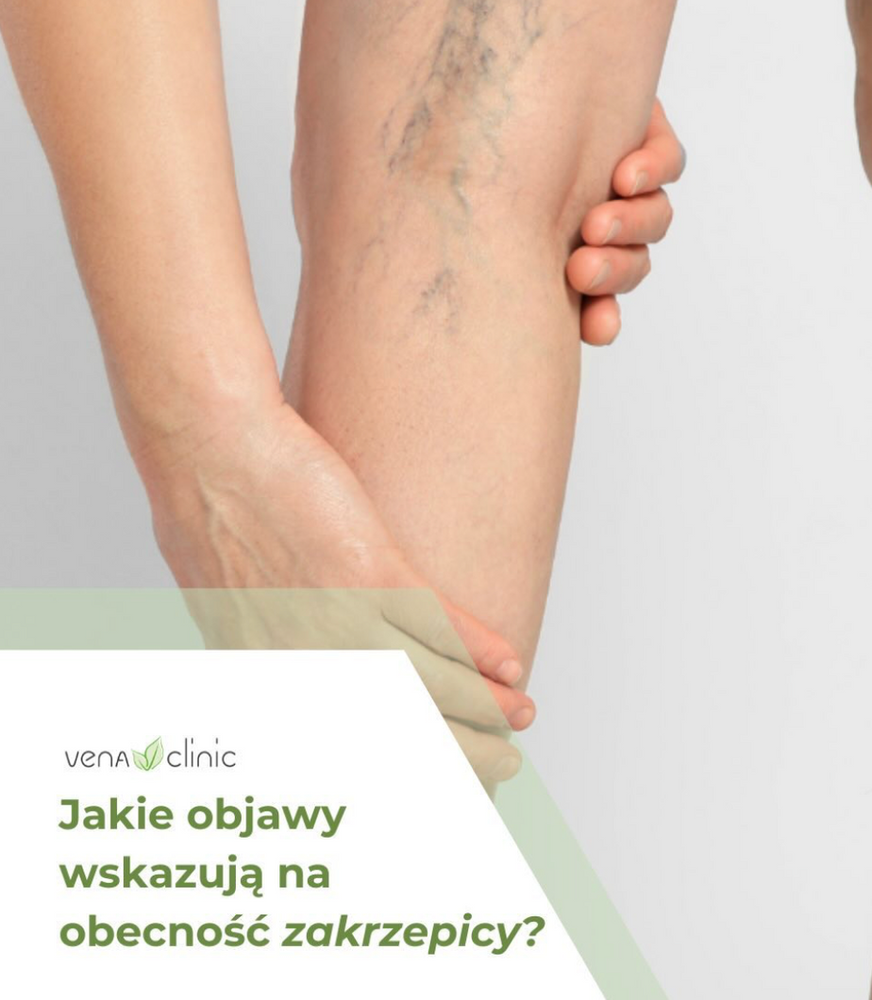 Jakie objawy wskazują na obecność zakrzepicy żył głębokich kończyn dolnych?