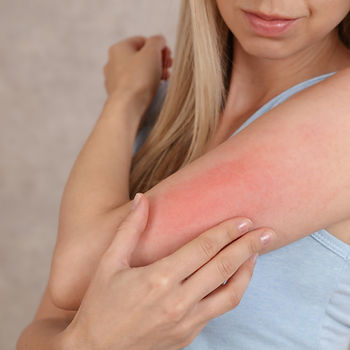Woman with irritated skin