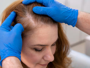 Hair Transplant in Hyderabad for Women: Understanding a Different Kind of Hair Loss Journey