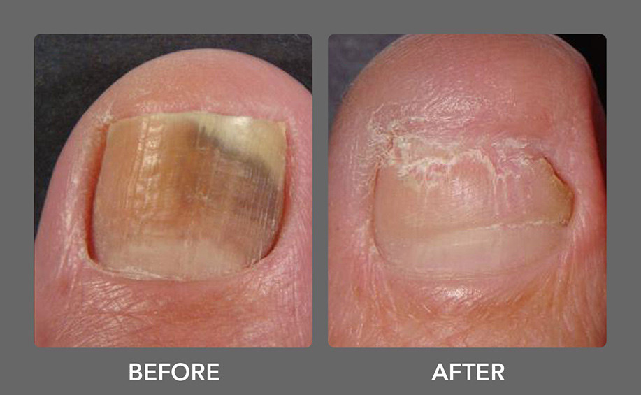 Toenail Fungus Fungal Nail Laser Treatment Jupiter West Palm Beach FL