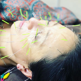 facial-acu.jpeg