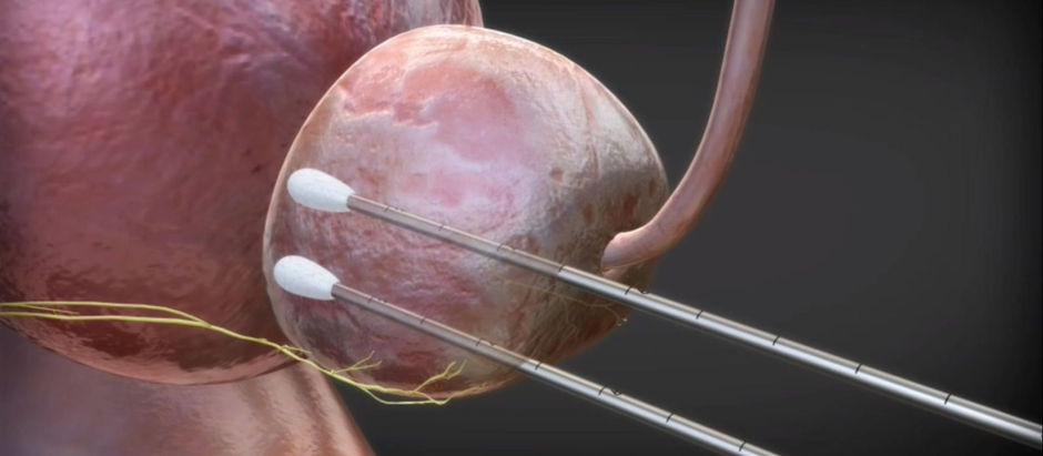 Un panel de la FDA aprobó el jueves un sistema de crioablación como alternativa a la cirugÃa para algunos pacientes con cáncer de mama en etapa temprana.