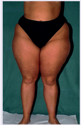 Paciente com lipedema. Imagem retirada do Consenso Internacional de Lipedema (2020)