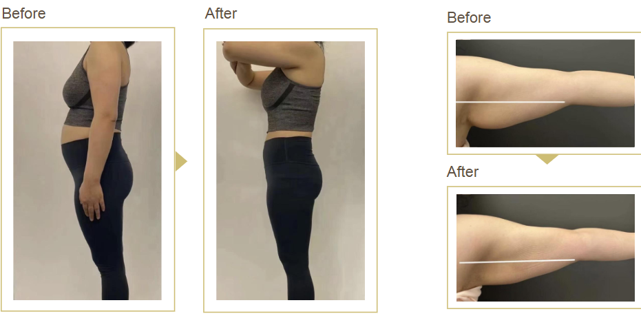 GLP & GLP-1 weight loss Greenwood IN