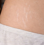 close up of a woman stretch marks