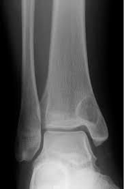 LE LESIONI INTRAOSSEE: COSA SONO, COME SI CLASSIFICANO E COME INTERVENIRE