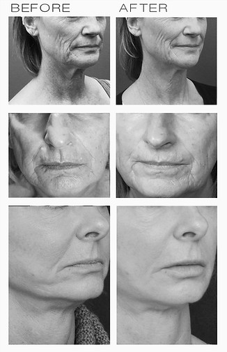 PHOTO REJUVENATION before & after.jpg
