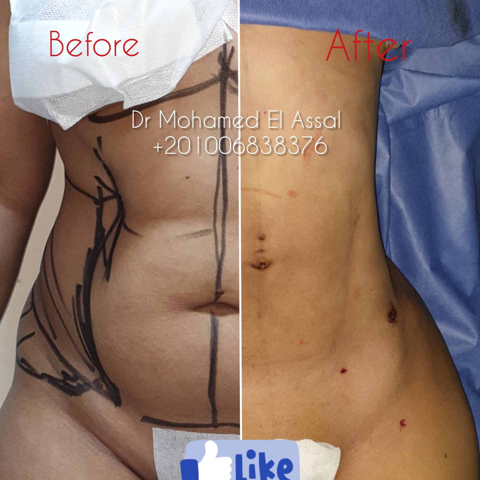 Integrated Liposuction