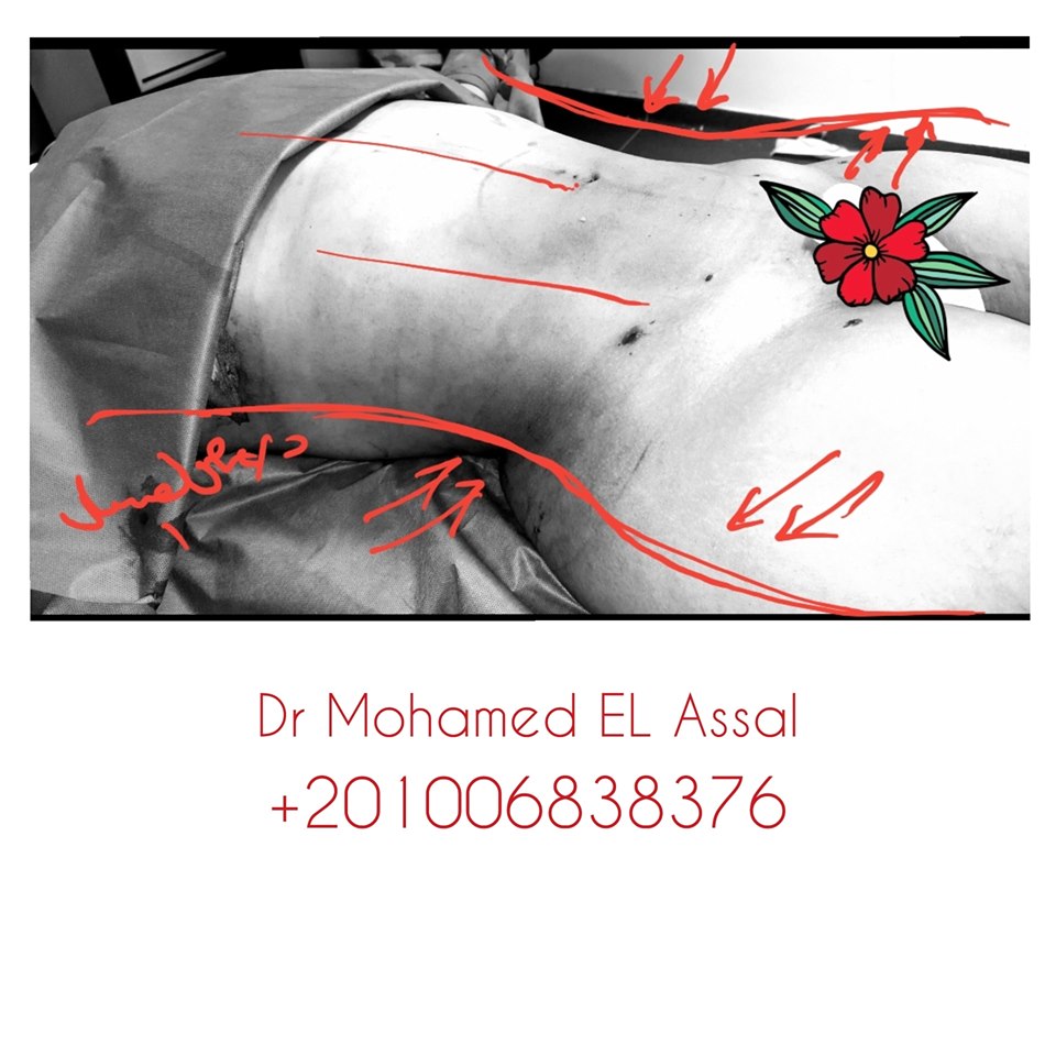 Integrated Liposclupture نحت الجسم