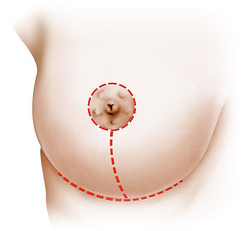 Anchor Incision