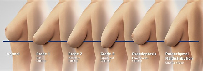DEGREES OF BREAST PTOSIS