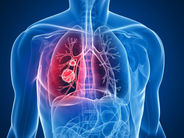 Անցած տարի ՀՀ-ում արձանագրվել է թոքի քաղցկեղի 903 նոր դեպք. ԱՆ