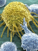 Վտանգավոր ազդանշաններ մարմնից. քաղցկեղի առաջին ախտանիշները, որոնք հաճախ աննկատ են մնում