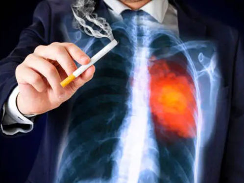 Բժիշկը զգուշացրել է «ծխողի հազի» վտանգների մասին