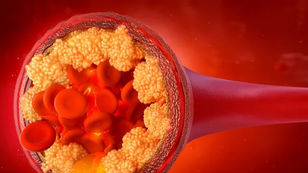 Խոլեստերինի մակարդակն իջեցնող դեղամիջոցներն ի վիճակի են ցավ առաջացնել մկաններում