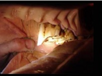 This is a large hook on a horse tooth.