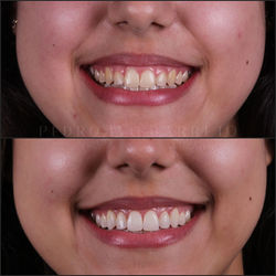 Cirurgia gengival e clareamento