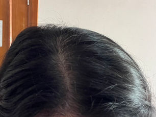 Exosome Treatment for Hair Loss Need to be Patient