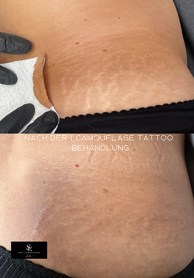  vorher nachher Camouflage Tattoo Pigmentierung Dehnungsstreifen am unteren Rücken