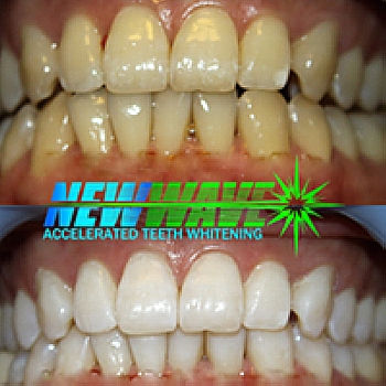 Before and After teeth whitening results at New Wave Teeth Whitening