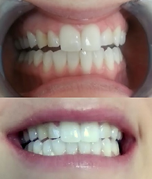 Teeth Whitening before & after on commonly faded teeth