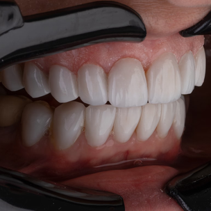 white teeth after professional teeth whitening treatment