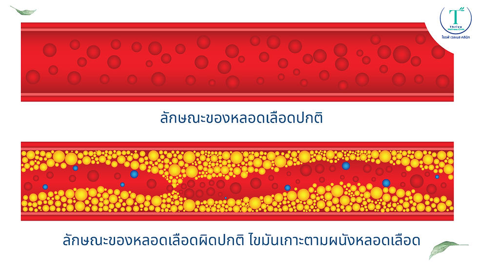 ลักษณะของหลอดเลือดปกติและหลอดเลือดที่มีไขมันเกาะตามผนังหลอดเลือด