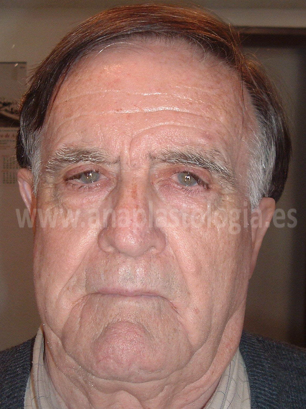Pabellón auricular adhesivo