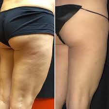 slimming treatment near me