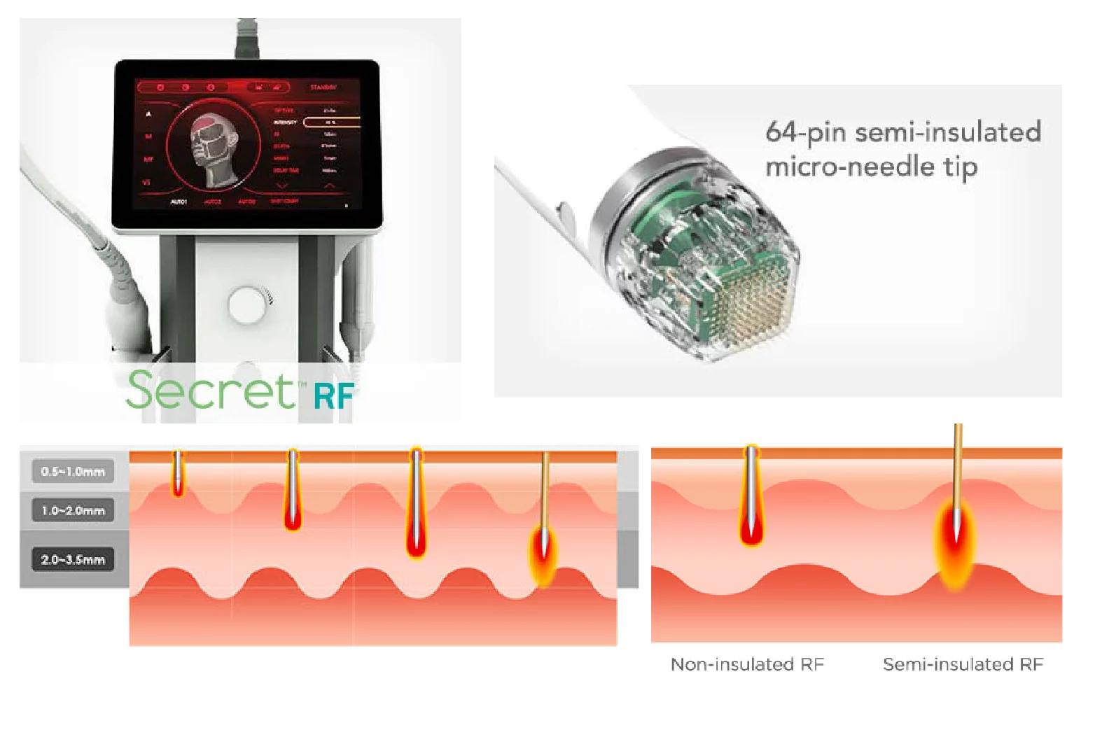 RF radiofrequente microneedling.