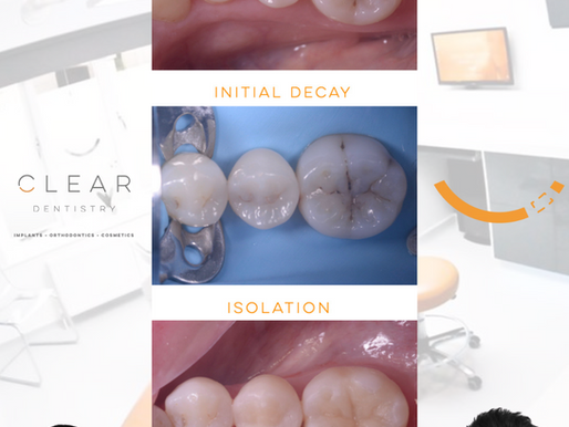  🦷✨ FILLINGS 🦷✨