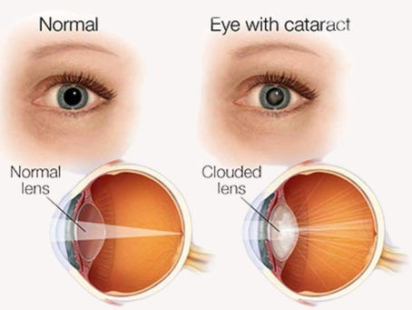 Cataract Surgeon in Gurgaon