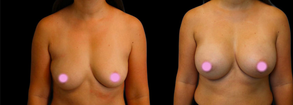 405cc Silicone Implants