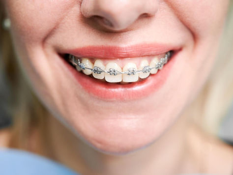 Braces vs. Clear Aligners: Which Orthodontic Treatment is Any Good?
