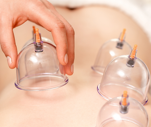 Cupping in action
