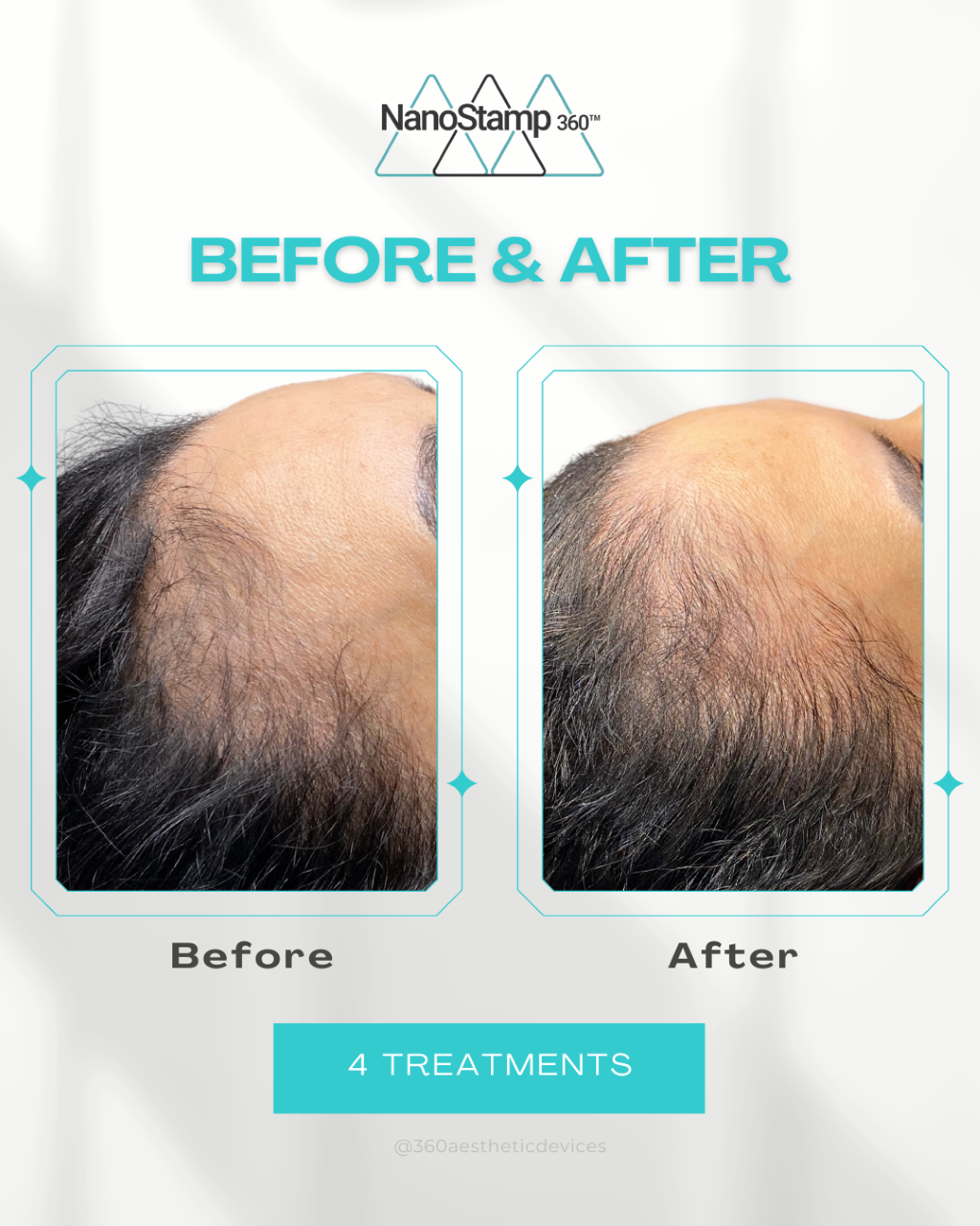 before and after