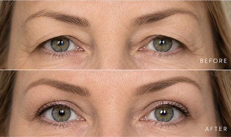 01-upper-blepharoplasty-image.png
