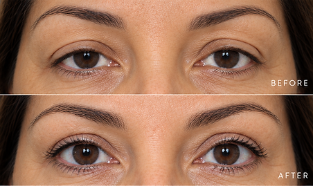02-ptosis-repair-image.png