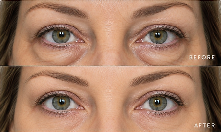 03-lower-blepharoplasty-image.png