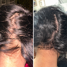 Avant après repousse cheveux – méthode Delta Skin Capillaire® déposée – protocole haut de gamme de mésothérapie naturelle pour cuir chevelu.