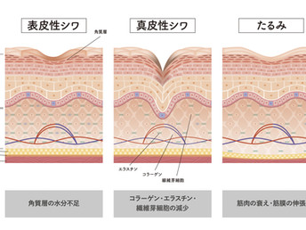 シワの種類の原因と対処法
