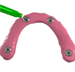 inserimento-seeger_in_protesi_inseritore_verde.webp