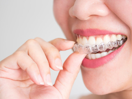Tècnica d’ortodòncia invisible Invisalign