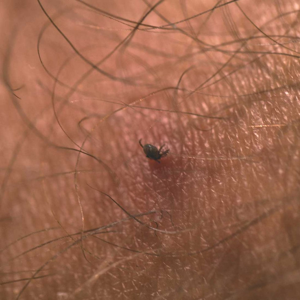 Tick in skin