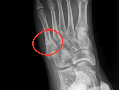 Jones Fracture