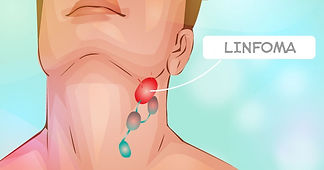 linfoma3.jpg