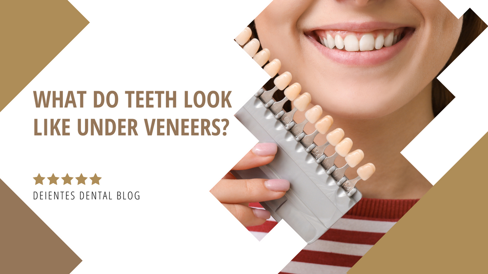 What Do Teeth Look Like Under Veneers?